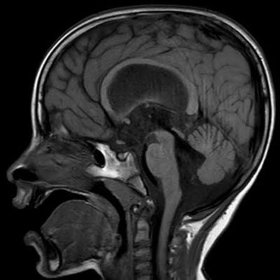 blakes pouch cyst 8 1 | Radiology24