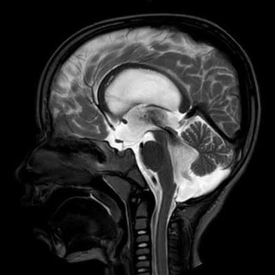 blakes pouch cyst 8 | Radiology24