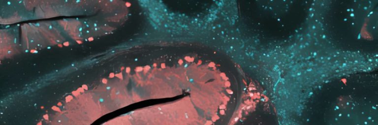 PICK DISEASE | Radiology24