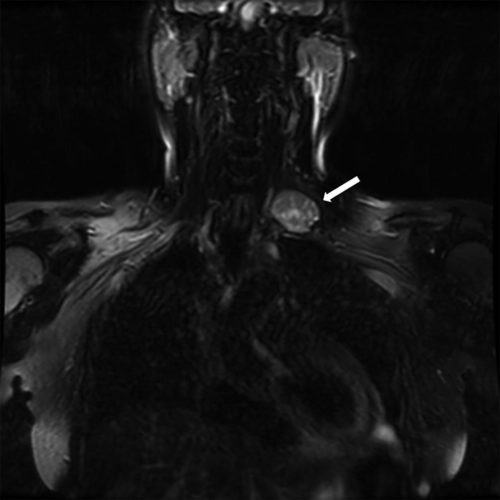 MRI demonstrating a left brachial plexus schwannoma (arrow).