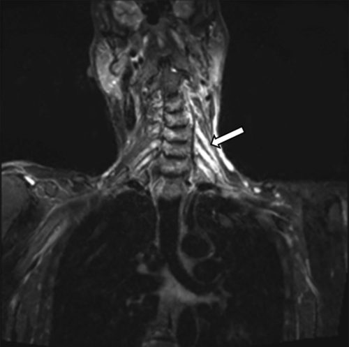 MRI demonstrating increased signal and thickening of the entire left brachial plexus