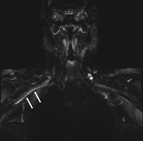 MRI of the brachial plexus demonstrating increased signal and multifocal constrictions