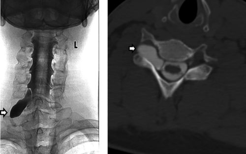 Myelogram and computed tomography