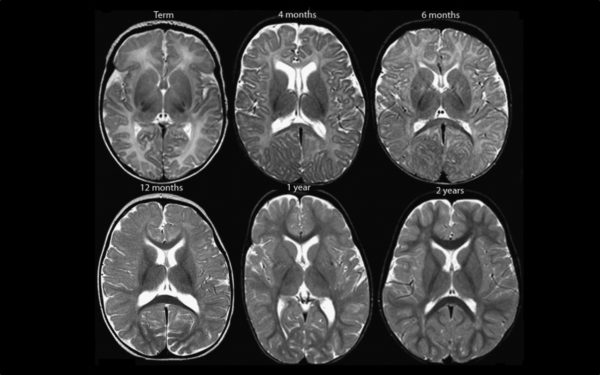 Normal Myelination T1