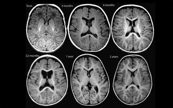 Normal Myelination T2