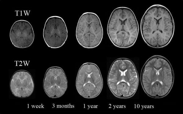 Normal Myelination T2 and T1