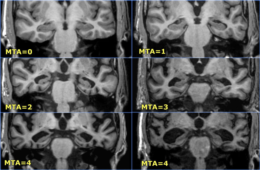 MTA score | Radiology24
