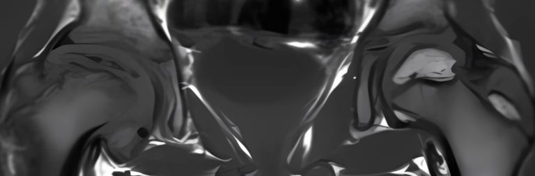 perthes disease blog | Radiology24