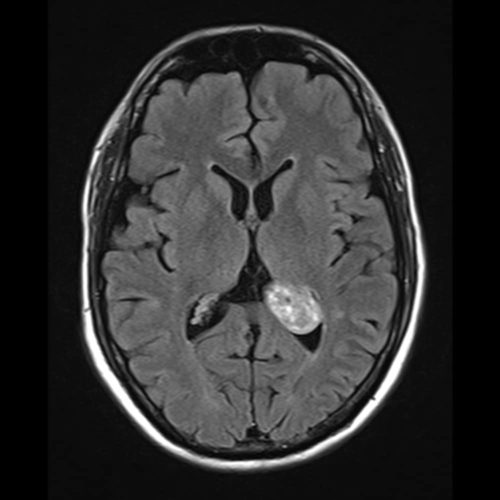 Choroid plexus xanthogranuloma flair | Radiology24