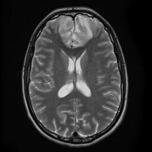 acute disseminated encephalomyelitis adem 5 2 | Radiology24