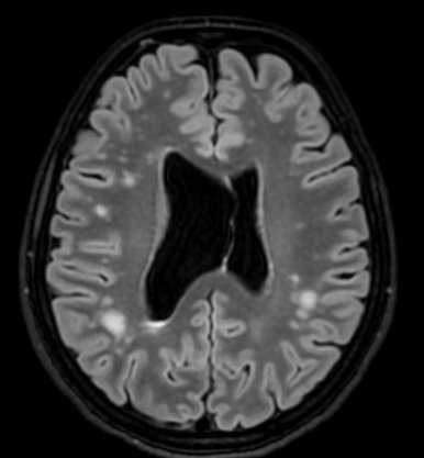 Myotonic dystrophy 3 | Radiology24