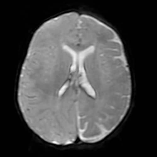 sturge weber DWI | Radiology24