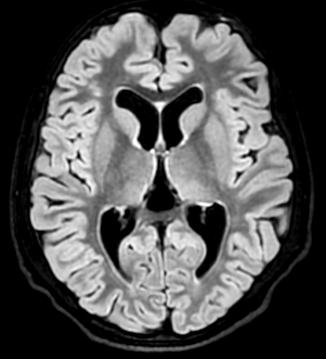 Myotonic dystrophy 1 | Radiology24
