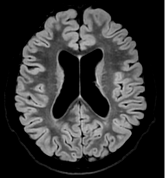 Myotonic dystrophy 2 | Radiology24
