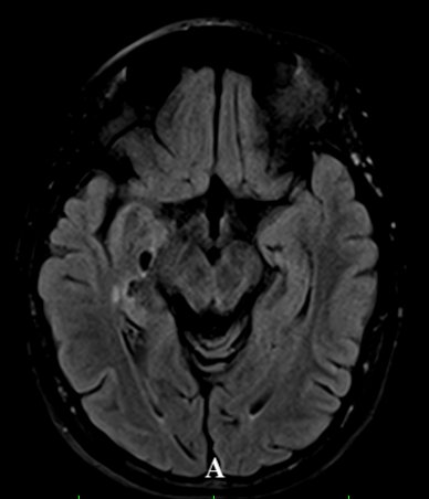 Myotonic dystrophy 4 | Radiology24