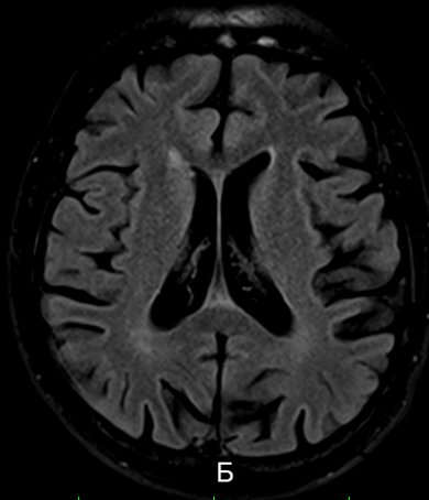 Myotonic dystrophy 5 | Radiology24