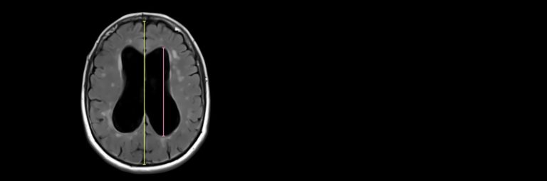 ALVI index | Radiology24