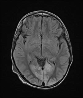 MELAS1 | Radiology24