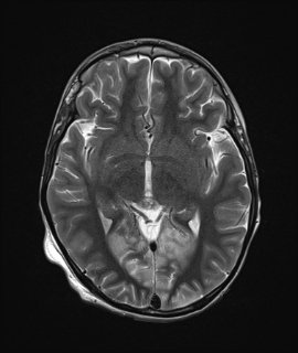 MELAS2 | Radiology24