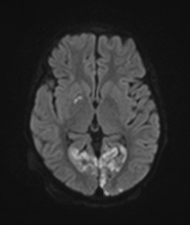 MELAS4 | Radiology24