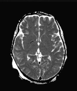 MELAS5 | Radiology24