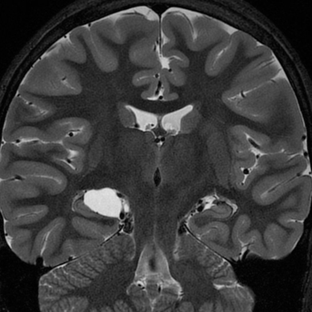 bichats cleft cyst 1 | Radiology24