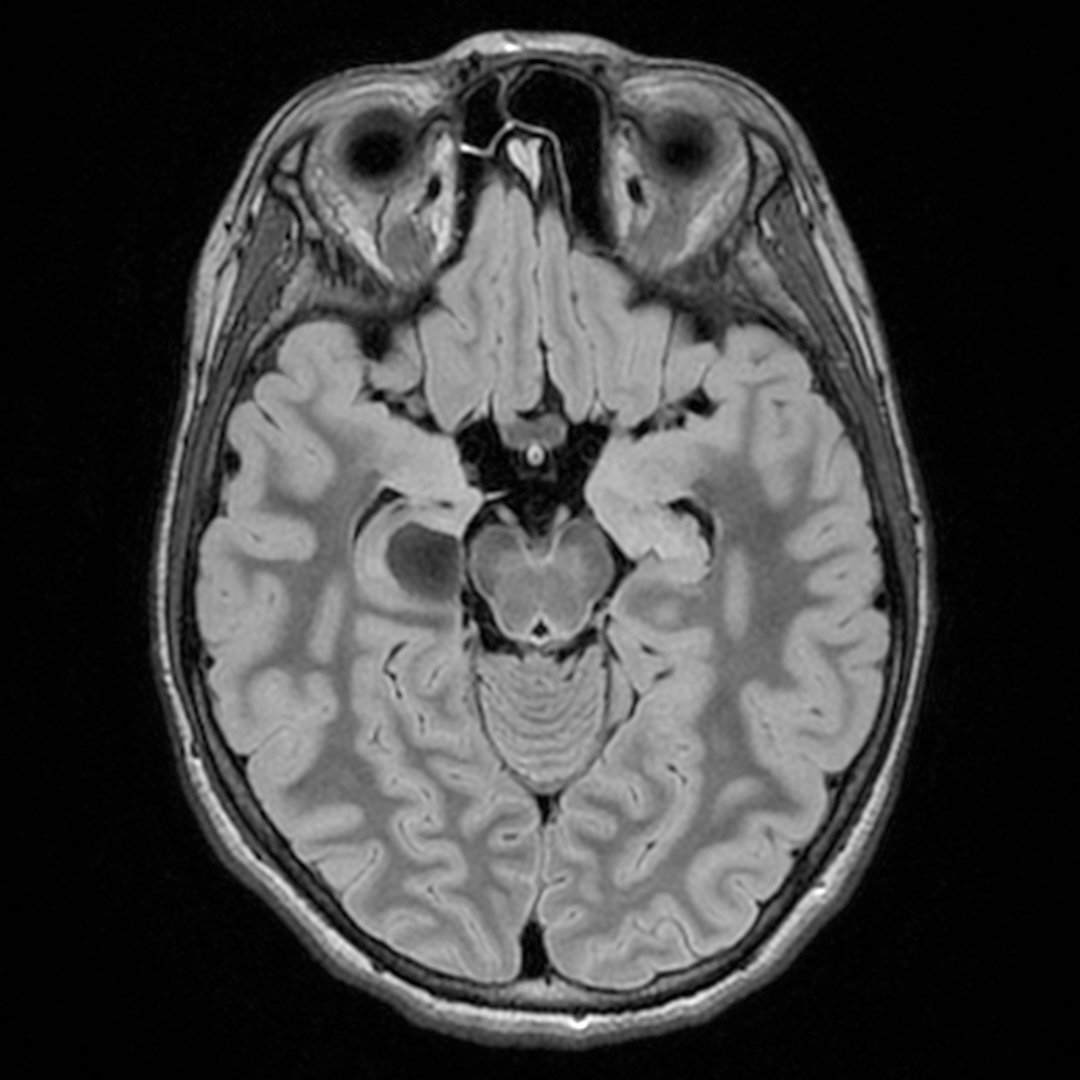 bichats cleft cyst 2 | Radiology24