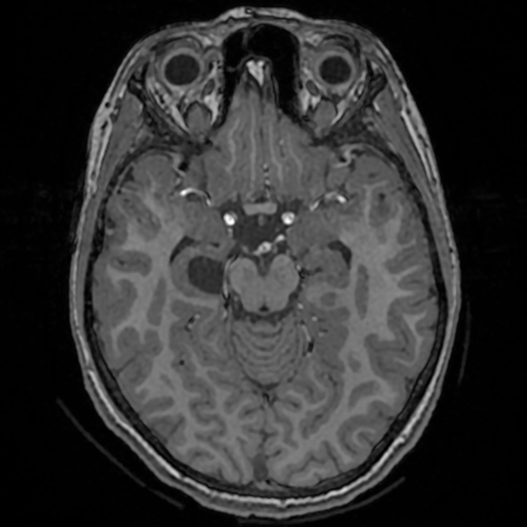 bichats cleft cyst 3 | Radiology24