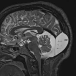retrocerebellar arachnoid cyst 2 | Radiology24