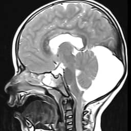 retrocerebellar arachnoid cyst 3 | Radiology24