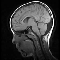 retrocerebellar arachnoid cyst 4 | Radiology24