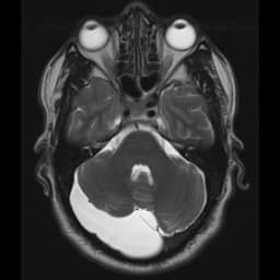 Ретроцеребеллярная киста 3 | Radiology24 retrocerebellar arachnoid cyst 1 | Radiology24