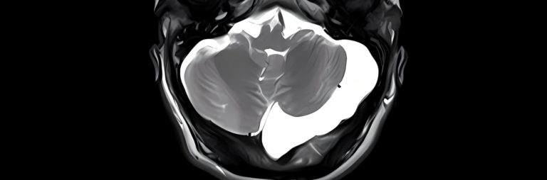 retrocerebellar cyst mri | Radiology24