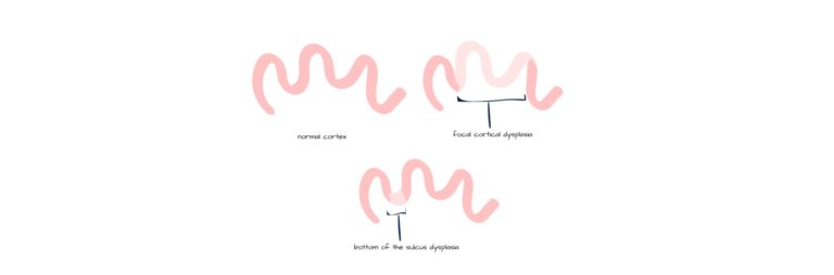 Cortical Dysplasia In The Brain | Radiology24