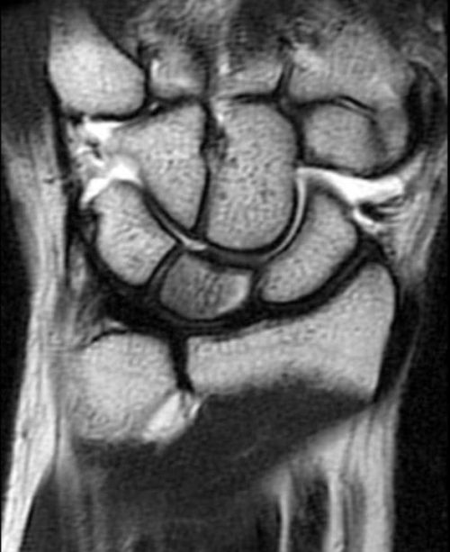 Болезнь Кинбека 1 | Radiology24