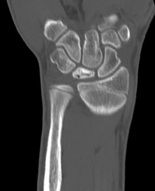 Болезнь Кинбека 2 | Radiology24