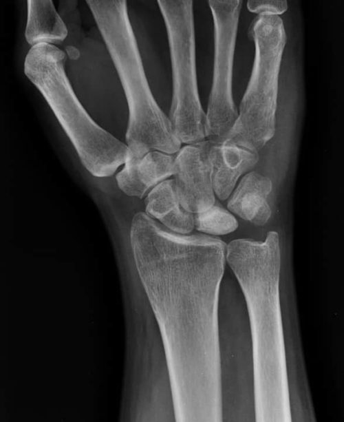 Болезнь Кинбека 3 | Radiology24