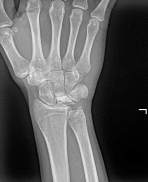 Болезнь Кинбека 4 | Radiology24